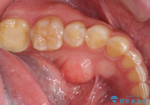 [骨の隆起で話しづらい]舌のスペースを確保する骨隆起切除術の治療前