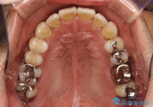 マウスピース矯正の代名詞　インビザラインによる前歯のクロスバイト治療の症例 治療後