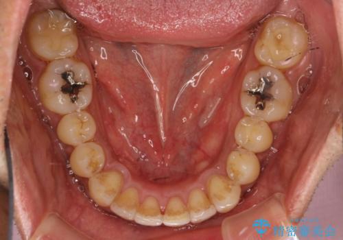 マウスピース矯正の代名詞　インビザラインによる前歯のクロスバイト治療の治療後