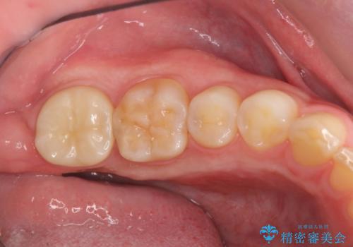 [骨の隆起で話しづらい]舌のスペースを確保する骨隆起切除術の治療後
