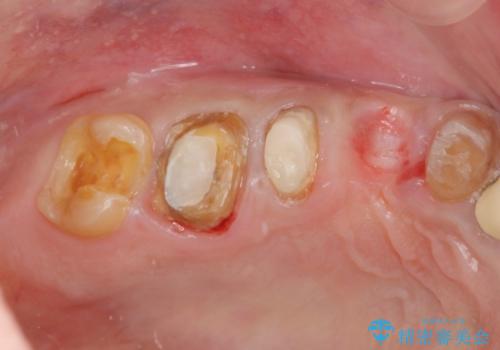 著しく腫れた歯ぐき　歯肉と歯の改善を行う歯周外科の治療前