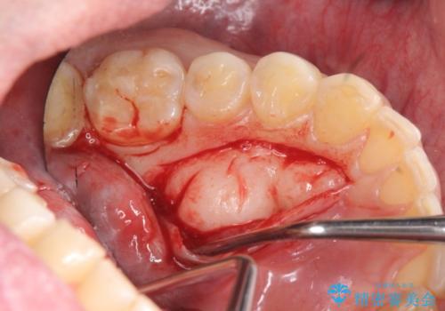 [骨の隆起で話しづらい]舌のスペースを確保する骨隆起切除術の治療中