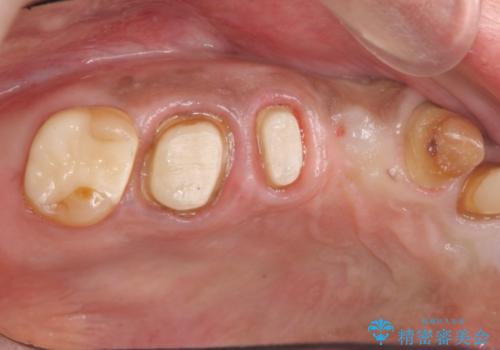 著しく腫れた歯ぐき　歯肉と歯の改善を行う歯周外科の治療中