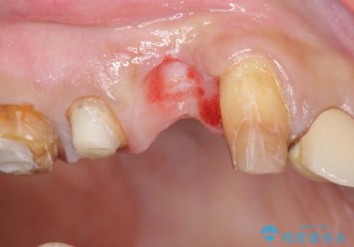 著しく腫れた歯ぐき　歯肉と歯の改善を行う歯周外科