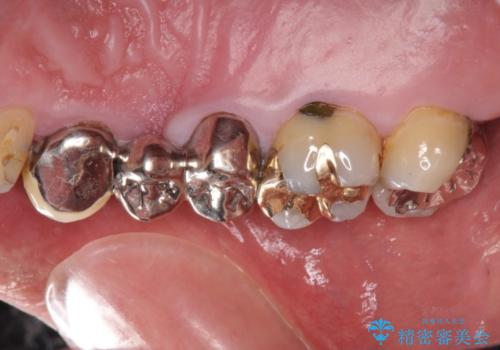 多発した縁下カリエス　歯周外科を併用する虫歯治療の治療前