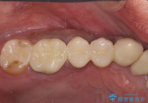 著しく腫れた歯ぐき　歯肉と歯の改善を行う歯周外科の治療後