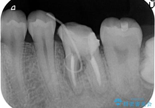 歯の根が割れた　インプラント治療によるかみ合わせの回復の治療前