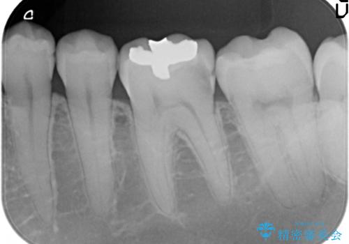 PGA(ゴールド)インレー　虫歯治療の治療前