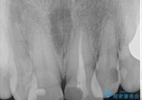 咬み合わせの修正を含めた前歯のオールセラミック修復　神経のない歯は根管治療からの治療前