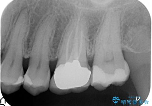 奥歯にものが詰まる　最後方臼歯の被せもので改善するの治療前