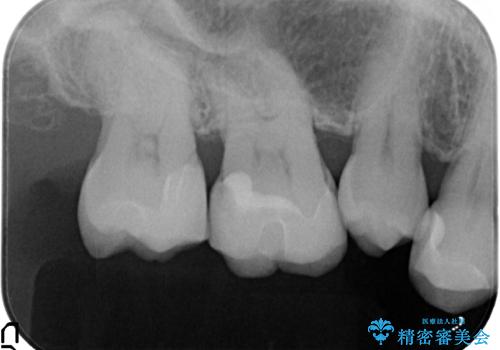 つめものが欠けた 奥歯のセラミックインレーの治療後