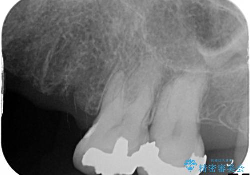 金属床義歯・PGA(ゴールド)クラウン　合わない入れ歯の新製　の治療前