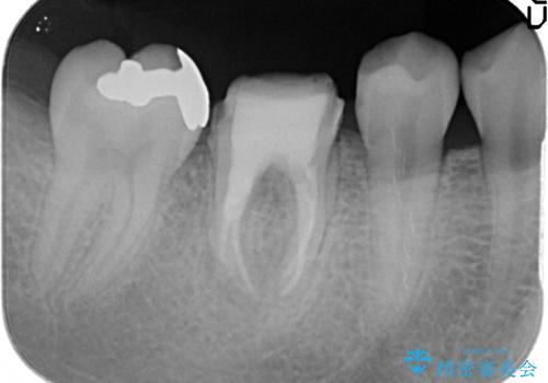 歯の高さがなく、被せ物が外れる　歯周外科手術で解決の治療中