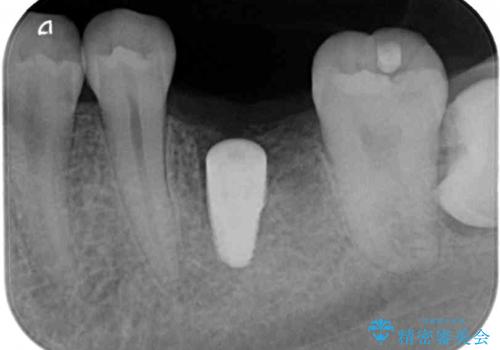 歯の根が割れた　インプラント治療によるかみ合わせの回復の治療中