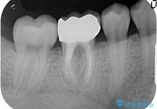 歯の高さがなく、被せ物が外れる　歯周外科手術で解決の治療後