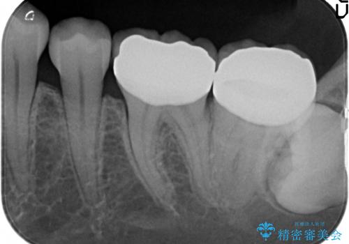 銀歯の周りが虫歯　セラミックにの治療後