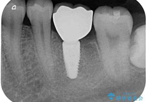歯の根が割れた　インプラント治療によるかみ合わせの回復の治療後