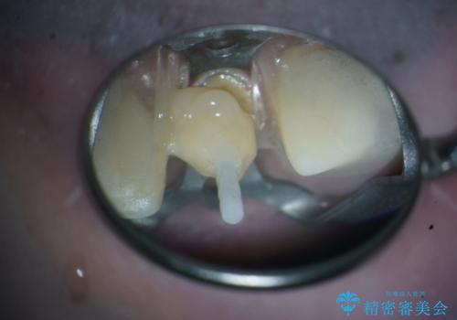 咬み合わせの修正を含めた前歯のオールセラミック修復　神経のない歯は根管治療からの治療中