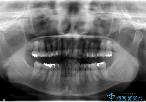 インビザラインによるかみ合わせの治療　奥歯の位置関係を是正してガタつきを治すの治療前