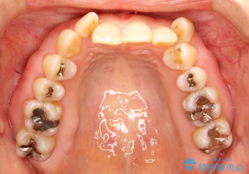 全顎矯正+セラミック治療による口腔内の総合リコンストラクションの症例 治療前