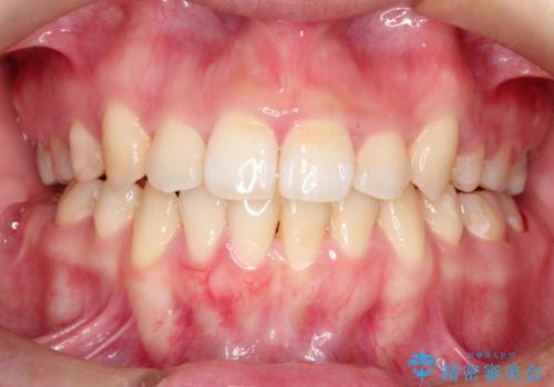 前歯がガタガタで食べ物が咬み切れない　フルリンガルによる裏側矯正の症例 治療後