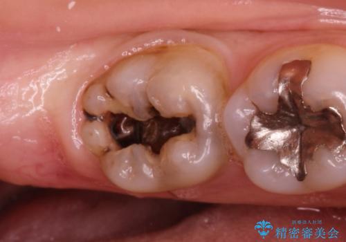 銀歯の内側で虫歯が再発　セラミックインレー修復で再発しないようにの症例 治療前