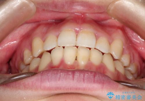 前歯がガタガタで食べ物が咬み切れない　フルリンガルによる裏側矯正の治療後