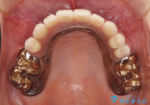 金属床義歯・PGA(ゴールド)クラウン　合わない入れ歯の新製　