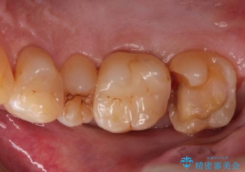 つめものが欠けた 奥歯のセラミックインレーの治療中