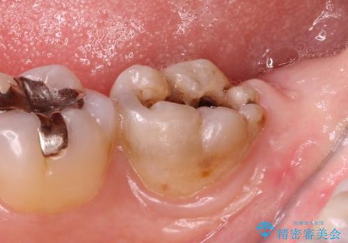 銀歯の内側で虫歯が再発　セラミックインレー修復で再発しないようにの治療前