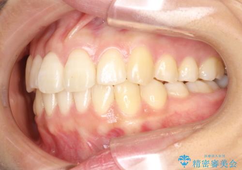 インビザライン治療　ガタつきの改善と一緒に、なるべく前歯を下げたいの治療後