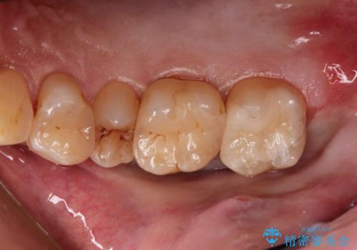 つめものが欠けた 奥歯のセラミックインレーの症例 治療後