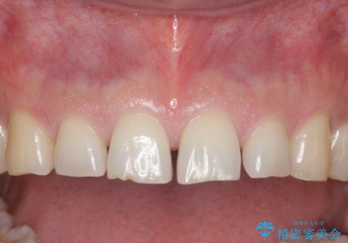 オールセラミッククラウン　上顎前歯部の隙間をセラミック矯正での治療前