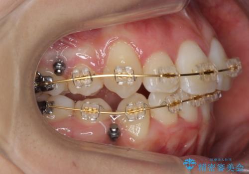 右だけ八重歯　最少限の抜歯の治療中