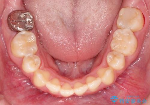 前歯がガタガタで食べ物が咬み切れない　フルリンガルによる裏側矯正の治療後
