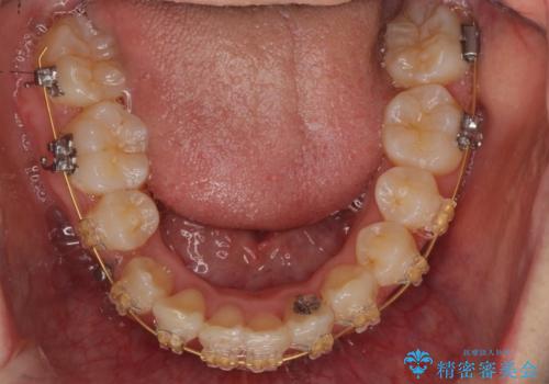 右だけ八重歯　最少限の抜歯の治療中