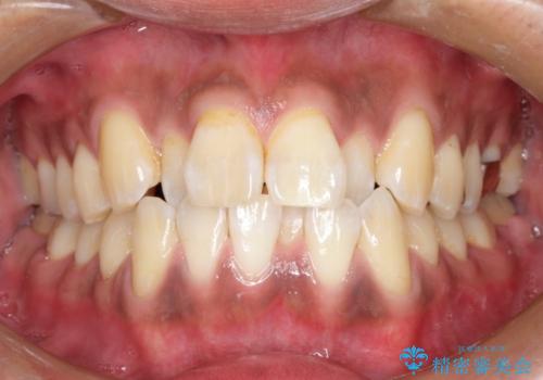 マウスピース矯正の代名詞　インビザラインによる前歯のクロスバイト治療の治療前