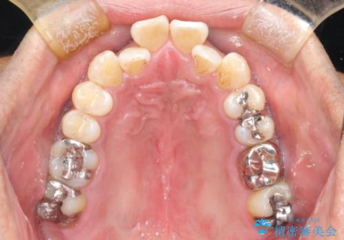 マウスピース矯正の代名詞　インビザラインによる前歯のクロスバイト治療の症例 治療前
