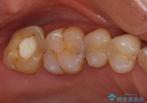 治療途中の奥歯をセラミックに　根管治療と審美歯科治療の症例 治療前