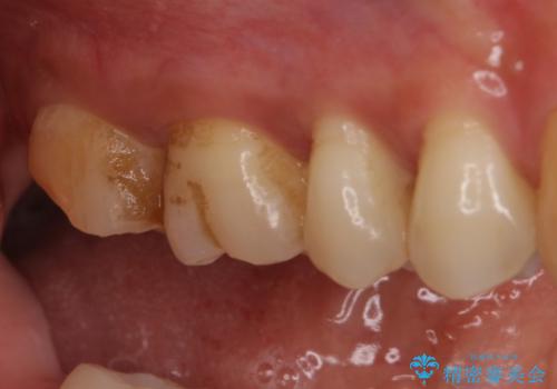 治療途中の奥歯をセラミックに　根管治療と審美歯科治療の治療前