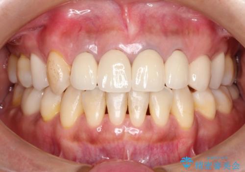 前歯(被せもの)の白さに合わせたホワイトニング　自然な仕上がりにの症例 治療前