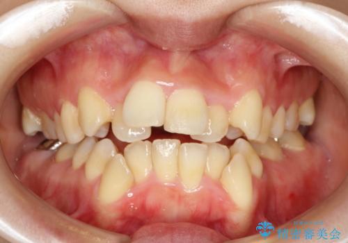 前歯がガタガタで食べ物が咬み切れない　フルリンガルによる裏側矯正の症例 治療前