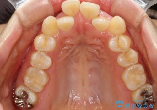 前歯がガタガタで食べ物が咬み切れない　フルリンガルによる裏側矯正の治療前