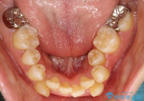 前歯がガタガタで食べ物が咬み切れない　フルリンガルによる裏側矯正の治療前