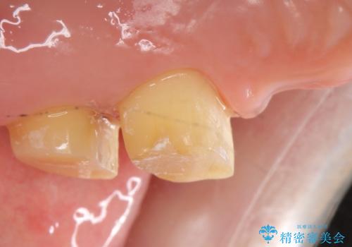 金属床義歯・PGA(ゴールド)クラウン　合わない入れ歯の新製　の治療中