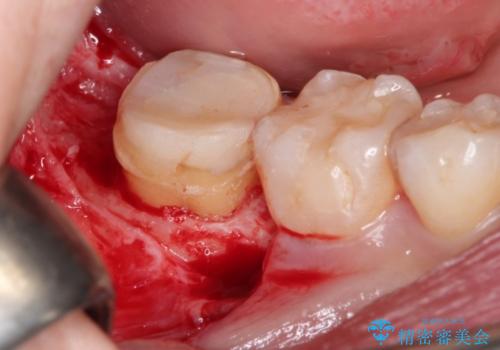 治療してもすぐに外れる歯。歯周外科後に、セラミッククラウンで解決!の治療中
