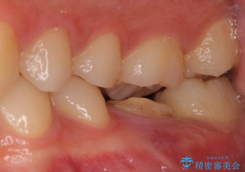 歯の根が割れた　インプラント治療によるかみ合わせの回復の症例 治療前