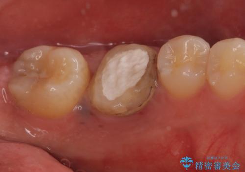 歯の根が割れた　インプラント治療によるかみ合わせの回復の治療前