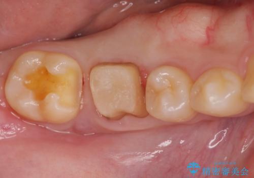 歯の高さがなく、被せ物が外れる　歯周外科手術で解決の治療中