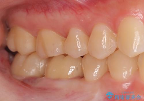歯の高さがなく、被せ物が外れる　歯周外科手術で解決の治療後
